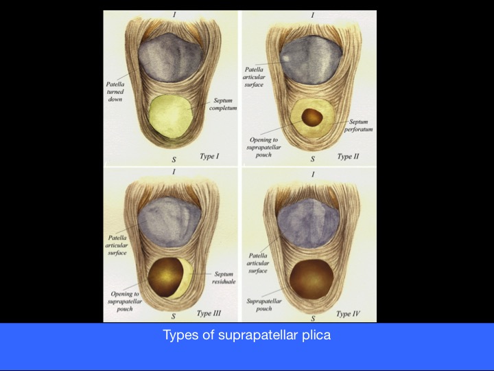 Figure 4 for case Symptomatic complete type of suprapatellar plica of the knee